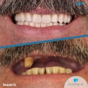 implant-dentar-fast-and-fixed-all-on-4-6