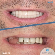 pacient-43-ani-implant-dentar-fast-and-fixed-total