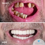 pacient-66-ani-implant-dentar-all-on-4-6