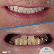pacient-74-ani-implant-dentar-fast-and-fixed