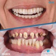 pacienta-44-ani-implant-dentar-all-on-4-6