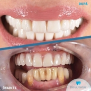 pacienta-51-ani-coroane-pe-implanturi-fatete-dentare