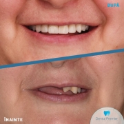 pacienta-54-ani-fast-smile-implant-all-on-4-6