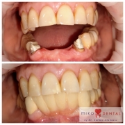 miko-implant-dentar-rapid-watermark