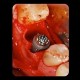 Curs implantologie dentara - Tratamentul edentatiilor cu ajutorul implanturilor
