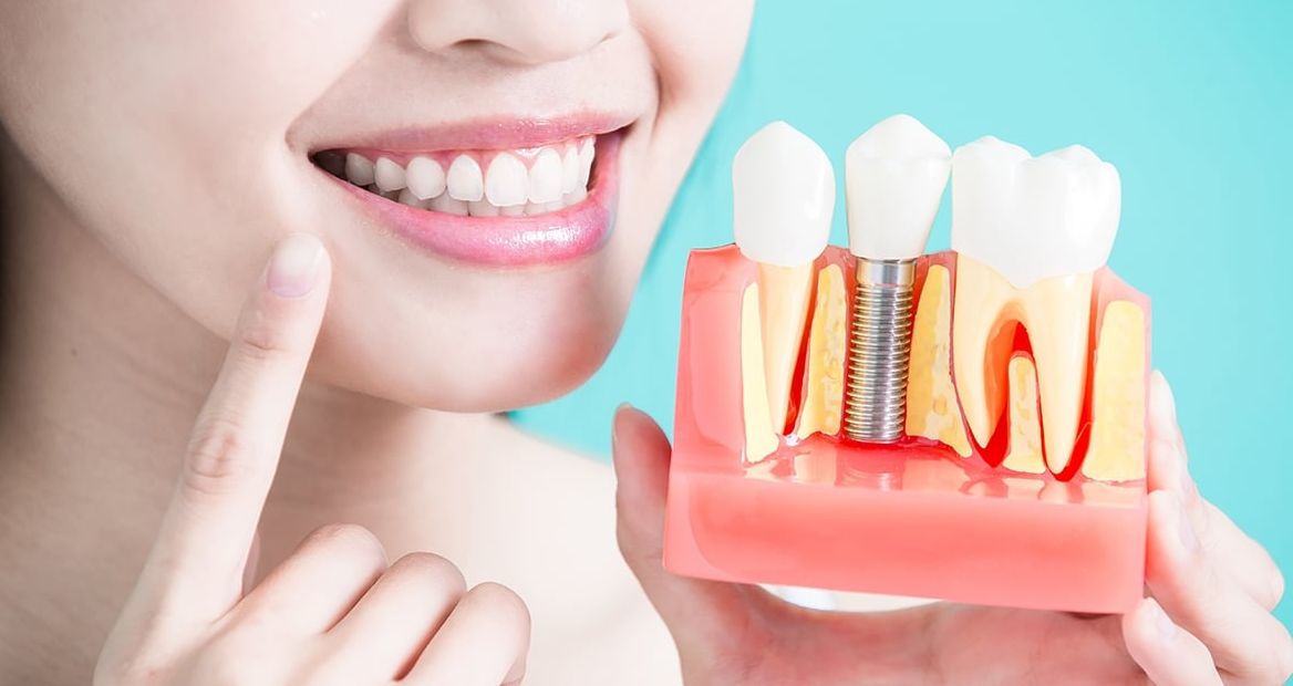 Oferta Clinici Implant Dentar