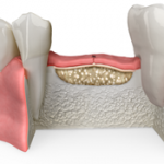 Aditia si augmentarea osoasa – Avantajele grefei osoase pentru implantul dentar