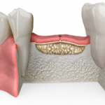 aditie de os dentar