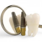 Alegand corect implantul dentar, puteti economisi pana la 70% din costuri