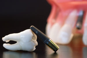 Cum sa alegi cel mai bun implant dentar, costuri, preturi