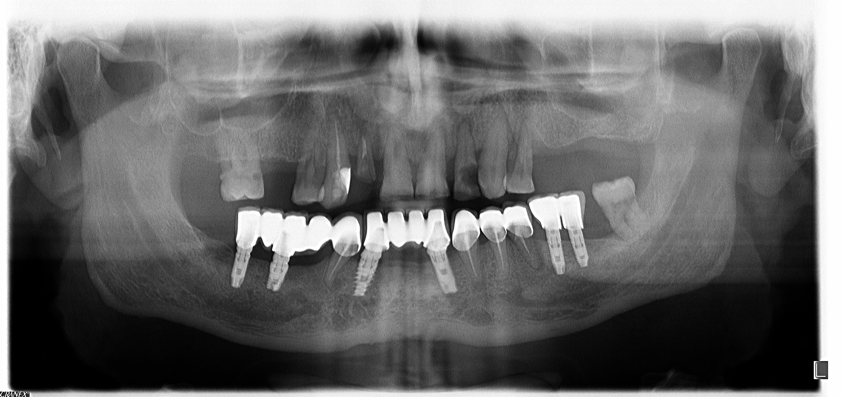 angelo-ct-pt-implanturi-dentare