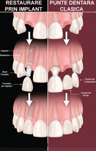 Implant dentar avantaje