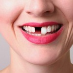Cauzele edentatiei sau pierderii dintilor si implantul dentar ca solutie de restaurare