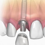 Cum sa alegeti cele mai bune implanturi dentare si care sunt factorii care influenteaza costul acestora