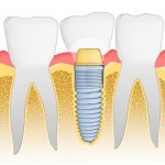 Consultatii stomatologice gratuite - Implant dentar