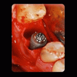 Curs implantologie dentara – Tratamentul edentatiilor cu ajutorul implanturilor, 16 si 25 octombrie 2015, Bucuresti