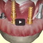 VIDEO DINTI INTR-O ZI: Restaurarea totala a danturii versus restaurarea unui singur dinte cu implant dentar rapid cu incarcare imediata