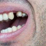 dinti lipsa implant dentar punte dentara