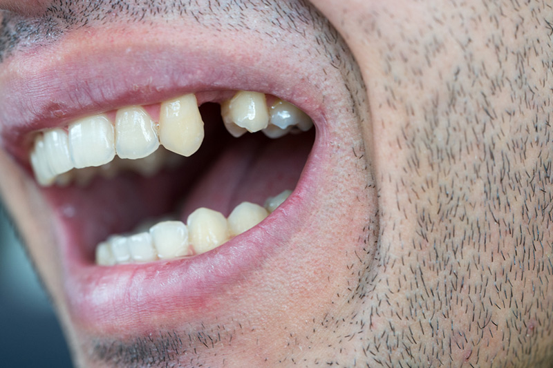 datând pe cineva cu dinți lipsă dating online australia țară