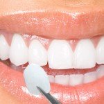 Fatetele dentare: Zambet de vedeta cu tehnologia DSD – Digital Smile Design!