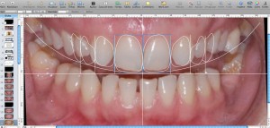 fatete dentare cu digital smile desing