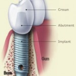 Glosar implantologie dentara