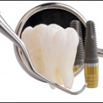 Ingrijirea de baza a implantului dentar in cazul inlocuirii unui singur dinte