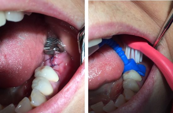 igiena dupa implantul dentar