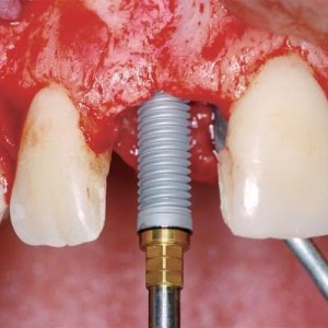 Ce presupune implantul dentar? Alcatuire implant, inserare