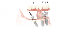 implant all on 4 nobel biocare