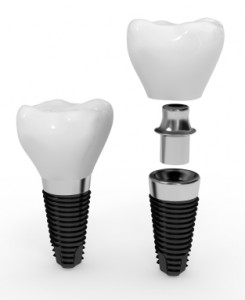 Implant dentar bont protetic coroana dentara