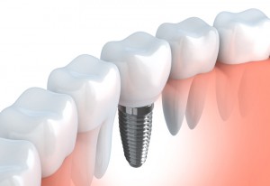 Implant dentar