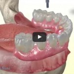 VIDEO si POZE DINTI INTR-O ZI – Restaurarea totala a dintilor de pe mandibula si maxilar cu implant dentar Fast and Fixed in 24h