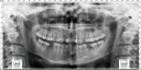 implant-dentar-dreapta-jos-georgiana implant-dentar-dreapta-jos-georgiana