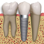 Implant dentar pasi | Realizarea implantului