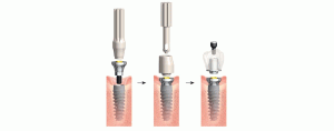 implant dentar nobel biocare on1