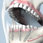 Implant dentar rapid Fast & Fixed, dinti intr-o zi: avantaje, preturi implanturi dentare Bredent