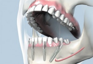 implant dentar rapid pret fast & fixed