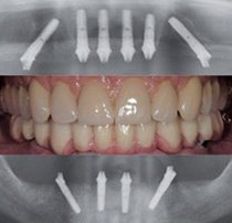 implanturi dentare rapide in 24 ore