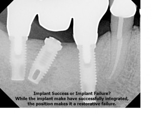 Implant dentar reusit versus gresit