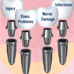 Implant dentar riscuri | Implanturi dentare probleme