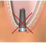 Implant dentar riscuri, Sinusuri afectate