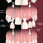 Implant dentar sau punte dentara
