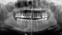 implant-dentar-stanga-sus-iulian