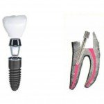 Implant dentar versus pivot sau stift dentar: definitii, diferente, poze & video