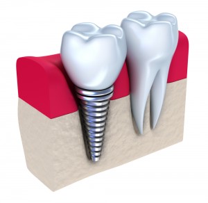implantologie dentara bucuresti plata in rate