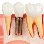 avantaje implanturi dentare arata natural estetic