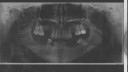 info-implanturi-dentare-aditie-os-iuly-1 info-implanturi-dentare-aditie-os-iuly-1