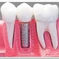 Informatii despre implantul dentar