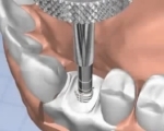 Video implant dentar si osteointegrarea implanturilor dentare: etapele realizarii